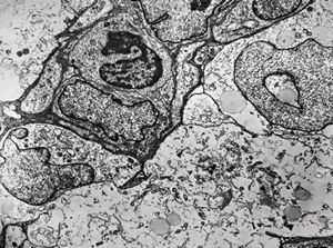 F,49y. | hemangioblastoma - brain